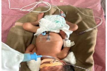 Baby of Khule Prasad Ashok - extremely premature